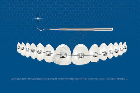 3d 矢量图 带牙套的逼真牙齿 对齐牙齿的咬合 牙列与牙套 牙套牙医治疗医生牙疼药品牙刷卫生支撑矫正凹痕背景图片
