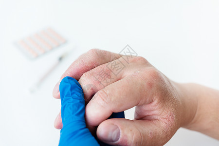 男性向医生显示手头上有红皮疹 皮肤发痒的原因可以是皮炎 干皮肤 烧伤 食物过敏 保健概念等手指高清图片素材