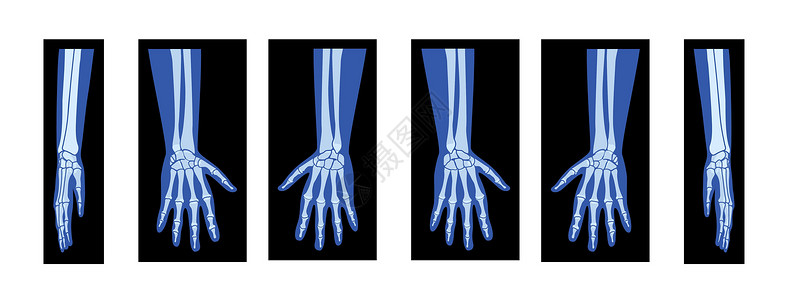 X光人体一组X光手与半径 人体 骨骼成年人的伦琴前侧视角插画