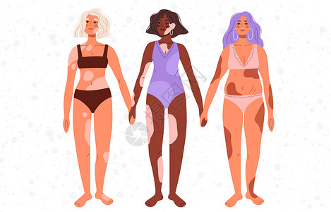 爱泳e族多样化的现代多种族女性与白斑集 穿着泳衣的女性不同身材类型排成一排 不同的身体阳性女性套装 世界白癜风日 平面矢量插图插画