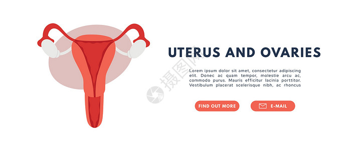 多囊卵巢女性生殖系统 宫颈和卵巢 平方矢量图激素女权囊肿图表海报生殖器多囊经期女孩生育力插画