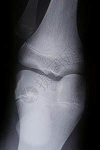 x射线黑色捷运药品膝盖中心照片医疗医院骶骨放射背景图片