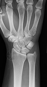 X射线手手腕软骨腕关节关节炎手指射线痛风背景图片