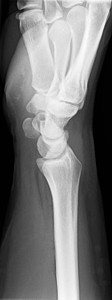X射线手射线关节炎手指软骨痛风手腕腕关节背景图片