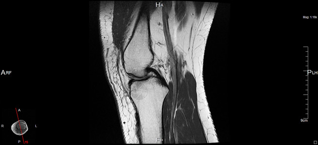 磁共振成像肌肉器官黑色白色左膝软骨身体考试神经辐射背景图片