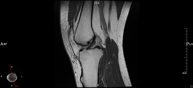 磁共振成像左膝神经白色肌肉器官软骨考试身体黑色关节背景图片