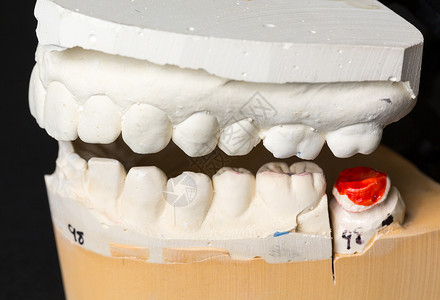 深覆合用于整牙术的假牙科学塑料铸件假肢微笑牌匾矫正正畸学衰变药品背景