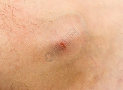 伤口有很多划痕外皮有作为背景的伤口背景