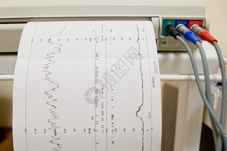心电图设备Ekk 图表纸上的心脏脉动结果(Ekk)背景