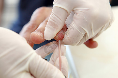 手指有血素材血液验血检查监视葡萄糖糖尿病测试考试大肠杆菌样本疾病测量背景