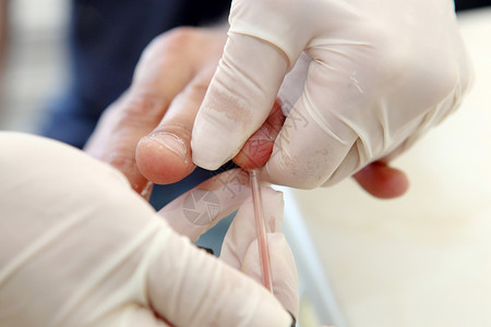 手指有血素材血液验血实验检查实验室仪表管子大肠杆菌病人医生考试监视背景