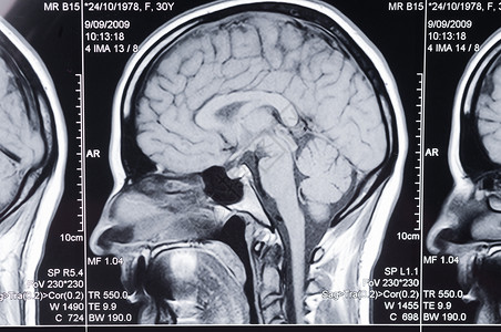 头部计算机轴心断层摄影扫描CAT医院轴向诊断谐振疾病射线病人保健卫生骨骼身体高清图片素材