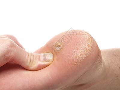 脚下干皮肤和骨老茧医生考试检查温泉工作室手指女性组织修脚背景图片