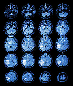 MRI 大脑 右脑叶上的脑瘤脑血管断层核磁共振医院肿瘤保健x射线扫描手术病人背景