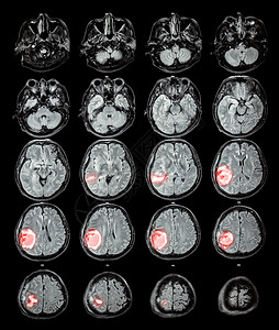 MRI 大脑 右脑叶上的脑瘤卫生男人医生电脑射线疾病科学扫描外科核磁共振背景