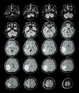 MRI 大脑 右脑叶上的脑瘤保健科学肿瘤扫描外科x射线电脑疾病卫生手术背景