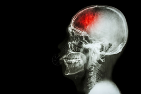 头骨骼航天器小血管事故左侧有中风和空白面积的胶片X射线头骨横向手术脑血管大脑身体骨骼颈椎病椎骨x射线医生外科背景