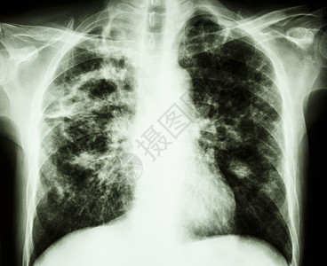 肺结节肺炎肺结核骨骼男人诊断空腔医院药品感染胸部纤维化x射线背景
