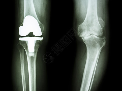 人造骨骼骨眼关节炎病人和人工关节的膝部医生骨骼男人保健股骨衰老疾病卫生射线金属背景