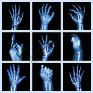 收集X光手相信号收藏数字卫生病人电影射线保健手指疾病背景图片