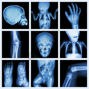 人类脚儿童身体的X光部分第2版手术情况新生外科画廊扫描儿科收藏疾病解剖学背景