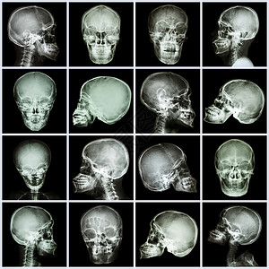 头骨骼收集X光头骨亚洲人放射科创伤编译器官骨骼疾病科学药品诊断x射线背景