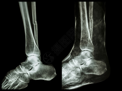 踝左图 腓骨 小腿骨 骨折轴 右图 用石膏固定碰撞诊断治疗疾病胫骨射线扫描病人x光疼痛背景