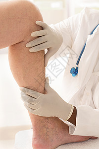 雄性腿上的血管变异高清图片