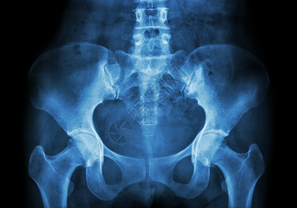 骨盆倾斜Pelvis的X光电影药品股骨医生医院疾病病人骨科疼痛骨骼椎骨背景