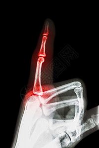 类风湿性关节炎 痛风性关节炎 拍摄 X 光食指和手 指向手指 并在手指处发炎方阵x光风湿病骨科指间风湿骨骼医生痛风医院背景