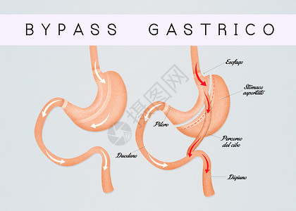 肠胃绕行方案器官插图饮食外科减肥肥胖保健肠子手术背景图片