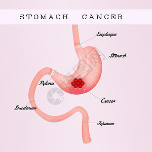 胃癌外科溃疡方案癌症插图冒号考试药品器官放射科背景
