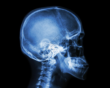 头骨骼胶片X光头颅和宫颈脊椎横向视图放射科身体病人药品颈椎病创伤椎骨x射线脊椎动物手术背景