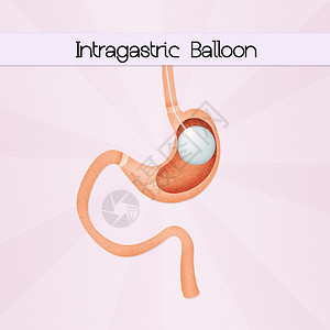 内气气球外科手术饮食肠子可调卫生减肥插图小袋肥胖器官保健背景图片