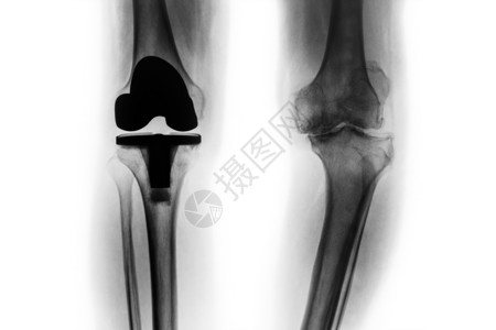 人造骨骼骨眼关节炎膝部和人工关节的X光片完全更换膝盖 孤立的背景x射线替代品骨科腓骨外科x光骨骼疼痛治疗胫骨背景