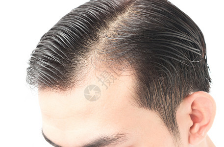 男青年在保健洗发水和艾滋病毒艾滋病方面的严重毛发问题医疗保险头发发型移植帮助白色医疗秃头头皮梳子背景图片