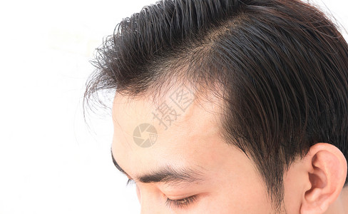 年轻人担心失去毛发的问题 健康护理洗发水造型师治疗梳子移植头发生长帮助发型男性头皮背景图片