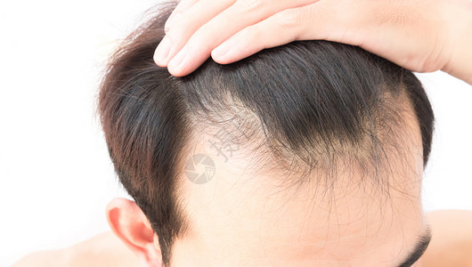 年轻人担心失去毛发的问题 健康护理洗发水男性治疗秃头头皮梳子帮助医疗白色生长造型师背景图片