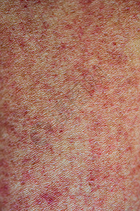 红皮疹皮肤向上皮肤卡高清图片