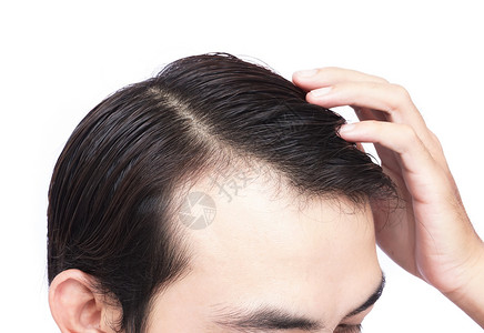 从后面家伙男青年在医疗保健 医疗和医疗方面严重发毛问题男性帮助发型头发损失白色头皮梳子假发男人背景