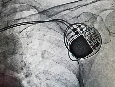 DDDD 复员方案起搏器高清图片