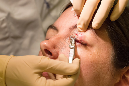 化脓性球菌保健概念     眼科检查和手术期间的查拉松眼睛细菌药品睑板眼皮女性大麦疼痛疾病医生背景
