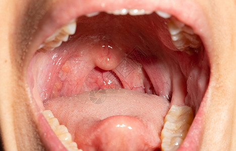 喉咙痛 喉咙肿胀 用后继剂闭合嘴张开血管病人药品流感口咽细胞咽喉卫生舌头上呼吸道卫生保健高清图片素材