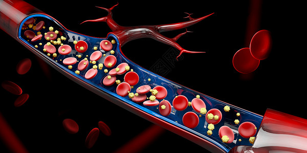 血栓形成3d 血液血管中的钙含量说明心血管动脉疾病中风红细胞毛细管静脉血栓生物药品背景