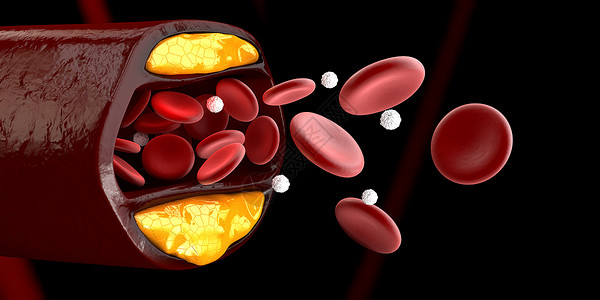 血管内皮3d 显示血细胞与凝固胆固醇隔离黑的立体积聚外科手术危险硬化动脉粥样硬化动脉身体疾病药品静脉背景