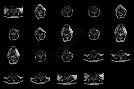 脐疝在C6-C7区段的双准中间介质外溢 并进行放射细胞病理学检查时 对caucasian 男性颈部区域进行一套横向MRI扫描背景