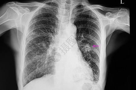 肺炎和肺结核图片