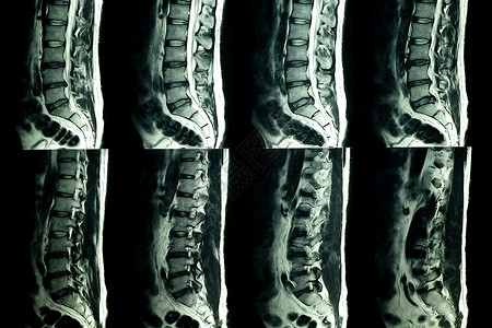 MRI 对患有慢性背部疼痛病人的腰脊椎进行核磁共振扫描压缩诊断光盘教育医院解剖学考试谐振腰椎技术骨骼高清图片素材