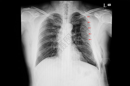 胸椎一名肋骨多处骨折病人的X光胸部膜背景