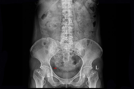 骨骼钙使用右阴极性尿质石的病人X光片背景